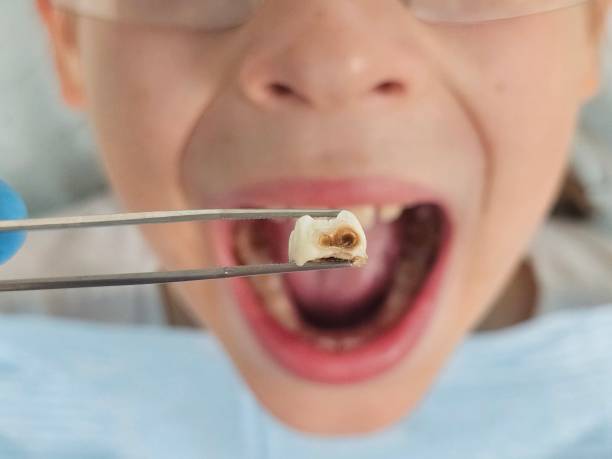 Best Knocked-Out Tooth Emergency  in Mount Zion, IL